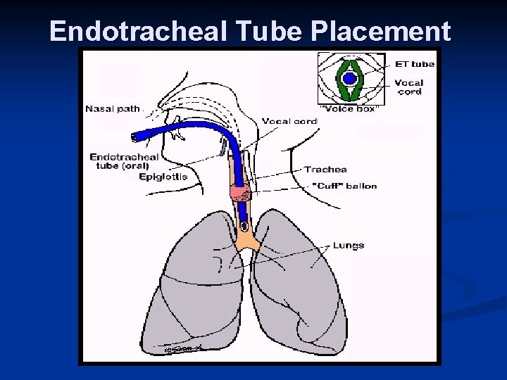 MECHANICAL VENTILATION INTUBATION n Endotracheal Intubation n n