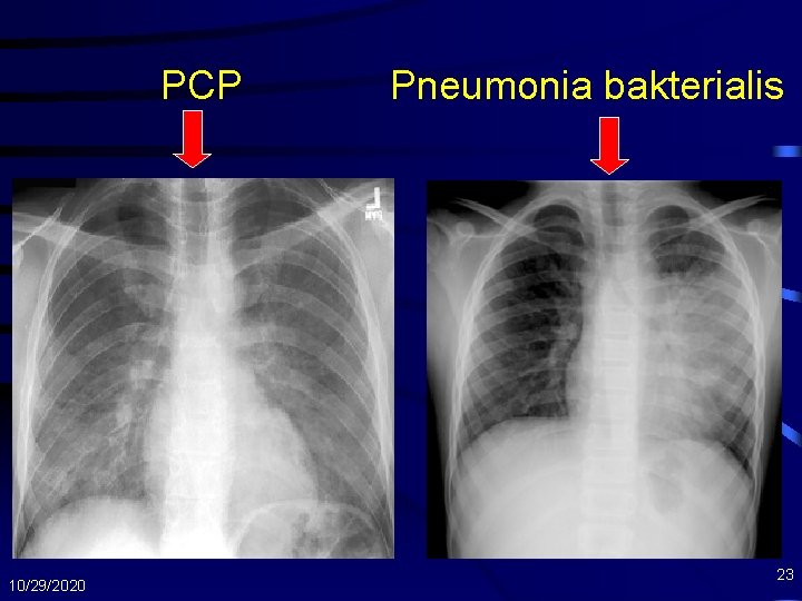  PCP 10/29/2020 Pneumonia bakterialis 23 