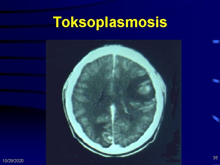 Toksoplasmosis 10/29/2020 35 