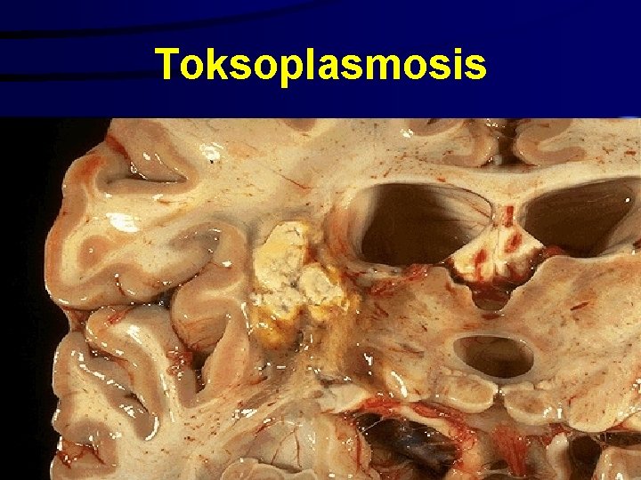 Toksoplasmosis 10/29/2020 36 