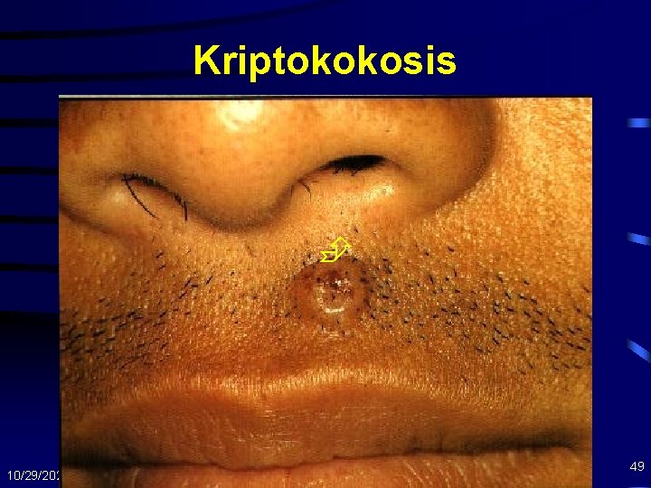 Kriptokokosis 10/29/2020 49 