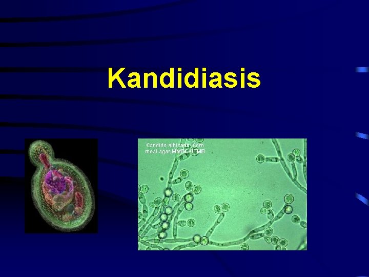 Kandidiasis 