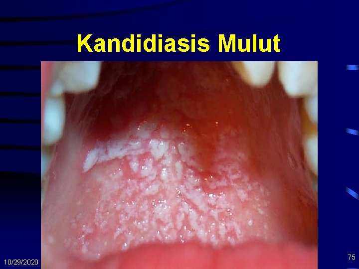 Kandidiasis Mulut 10/29/2020 75 