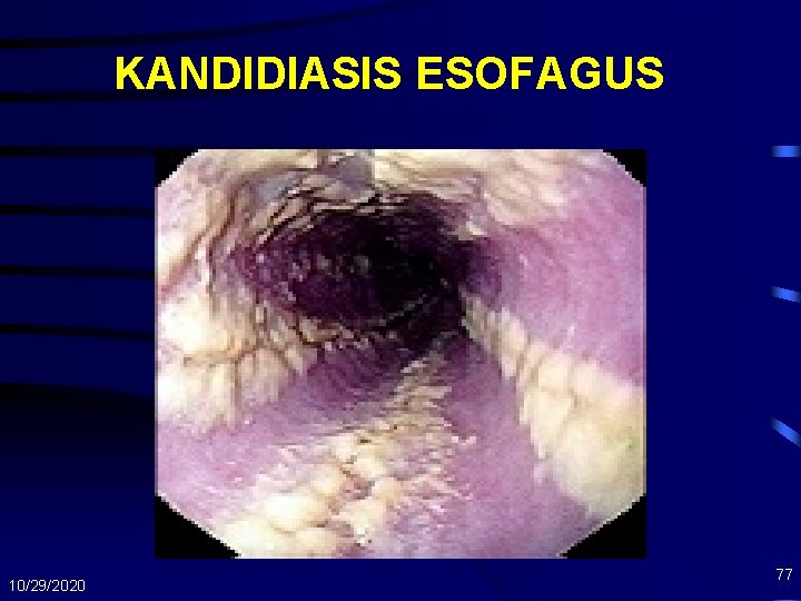 KANDIDIASIS ESOFAGUS 10/29/2020 77 