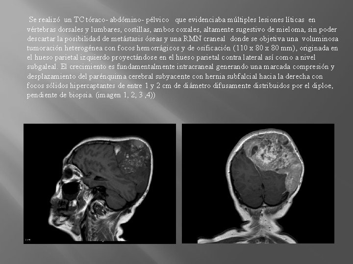  Se realizó un TC tóraco- abdómino- pélvico que evidenciaba múltiples lesiones líticas en