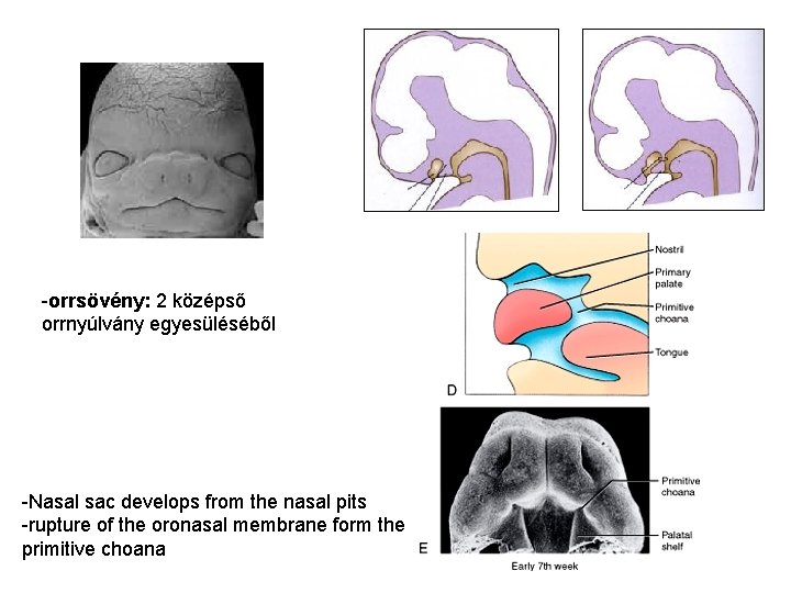-orrsövény: 2 középső orrnyúlvány egyesüléséből -Nasal sac develops from the nasal pits -rupture of