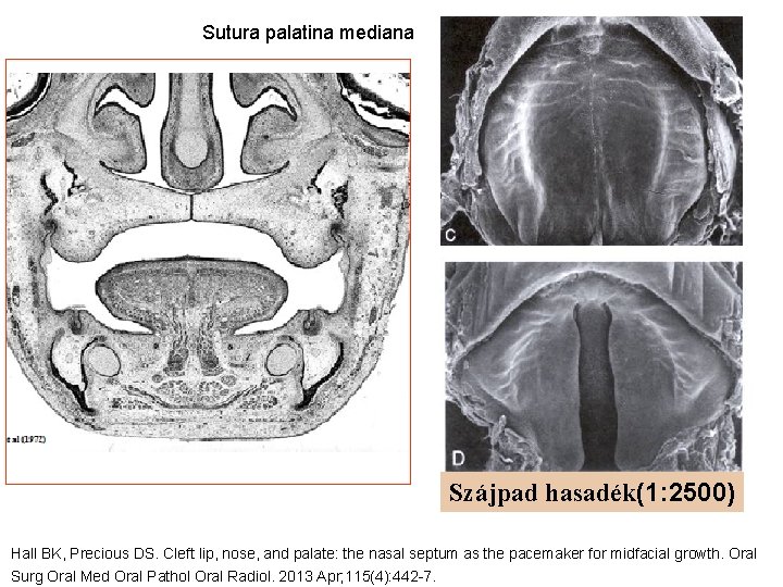 Sutura palatina mediana Szájpad hasadék(1: 2500) Hall BK, Precious DS. Cleft lip, nose, and