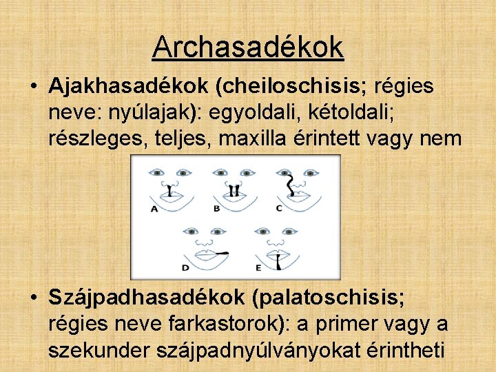 Archasadékok • Ajakhasadékok (cheiloschisis; régies neve: nyúlajak): egyoldali, kétoldali; részleges, teljes, maxilla érintett vagy