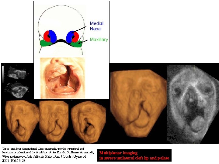 Three- and four-dimensional ultrasonography for the structural and functional evaluation of the fetal face.