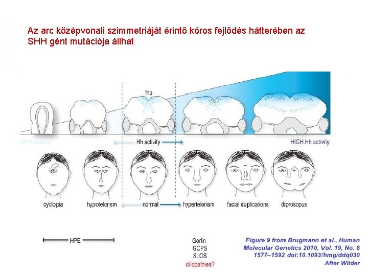 Az arc középvonali szimmetriáját érintő kóros fejlődés hátterében az SHH gént mutációja állhat 