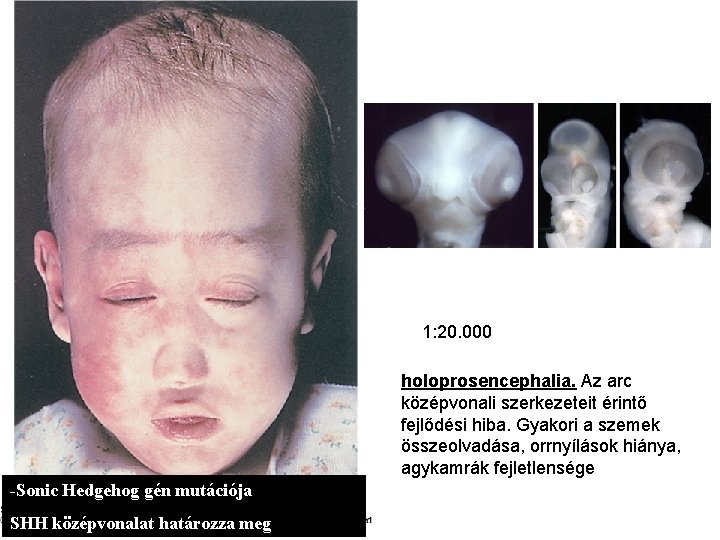 1: 20. 000 holoprosencephalia. Az arc középvonali szerkezeteit érintő fejlődési hiba. Gyakori a szemek