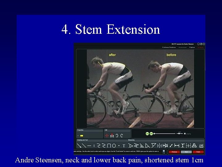 4. Stem Extension Andre Steensen, neck and lower back pain, shortened stem 1 cm