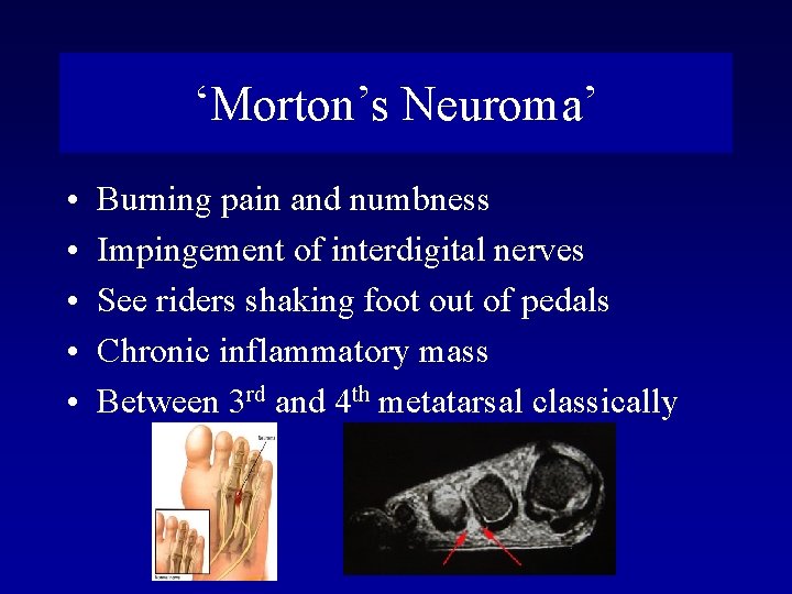 ‘Morton’s Neuroma’ • • • Burning pain and numbness Impingement of interdigital nerves See