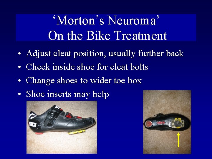 ‘Morton’s Neuroma’ On the Bike Treatment • • Adjust cleat position, usually further back