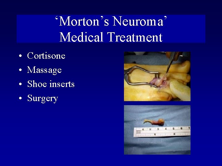 ‘Morton’s Neuroma’ Medical Treatment • • Cortisone Massage Shoe inserts Surgery 