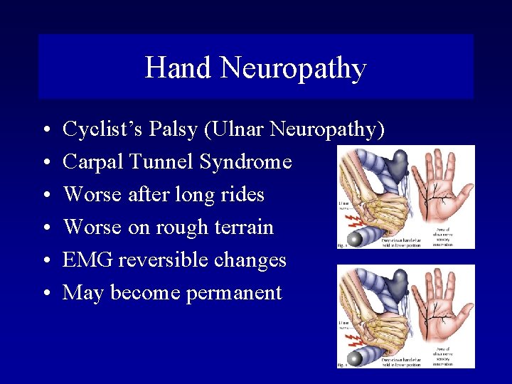Hand Neuropathy • • • Cyclist’s Palsy (Ulnar Neuropathy) Carpal Tunnel Syndrome Worse after