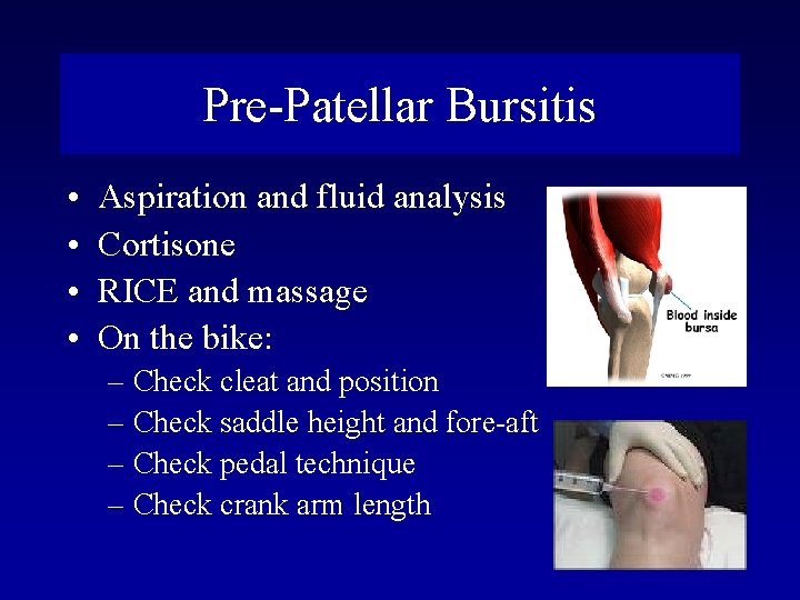 Pre-Patellar Bursitis • • Aspiration and fluid analysis Cortisone RICE and massage On the