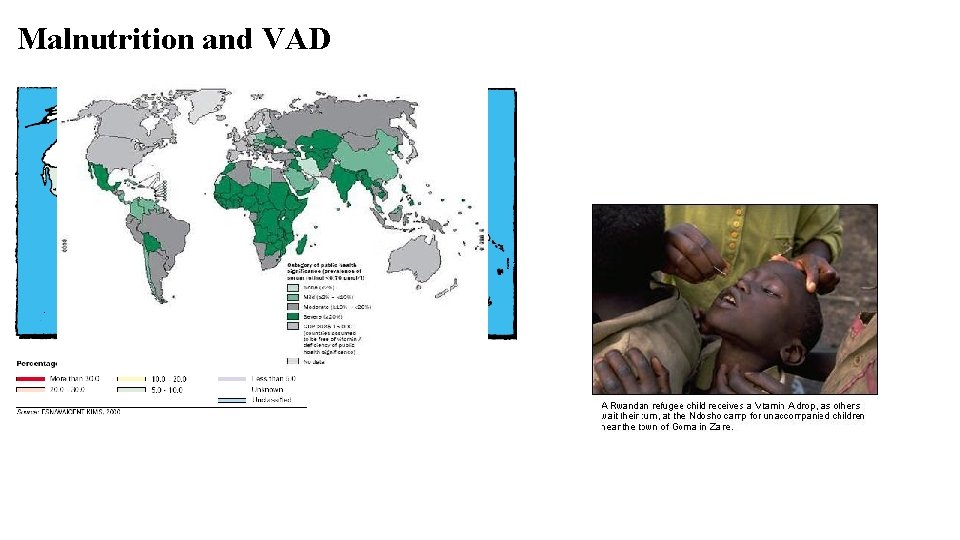 Malnutrition and VAD 