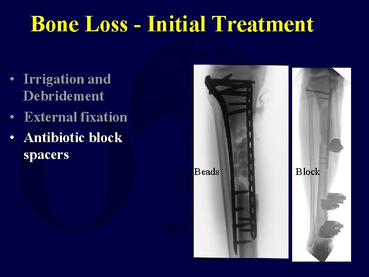 Bone Loss - Initial Treatment • Irrigation and Debridement • External fixation • Antibiotic