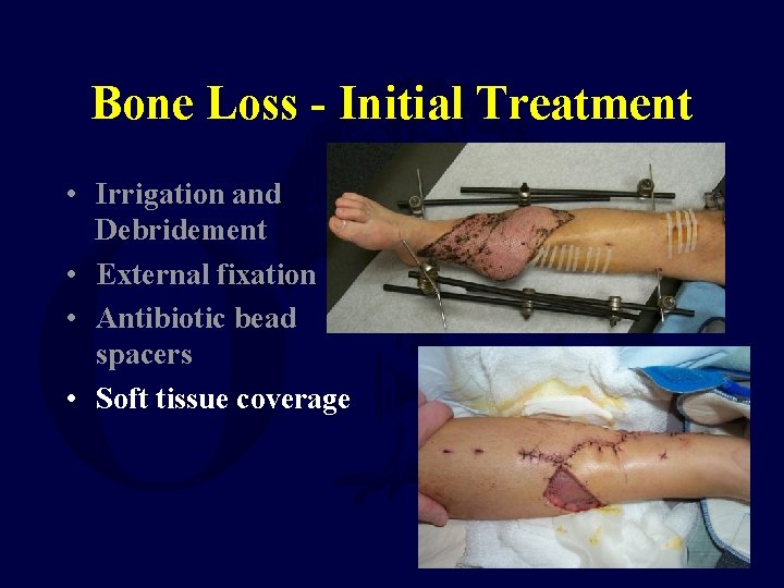 Bone Loss - Initial Treatment • Irrigation and Debridement • External fixation • Antibiotic