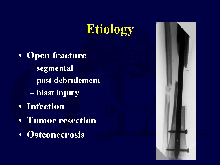 Etiology • Open fracture – segmental – post debridement – blast injury • Infection