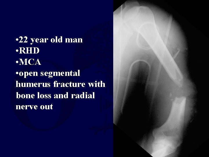  • 22 year old man • RHD • MCA • open segmental humerus