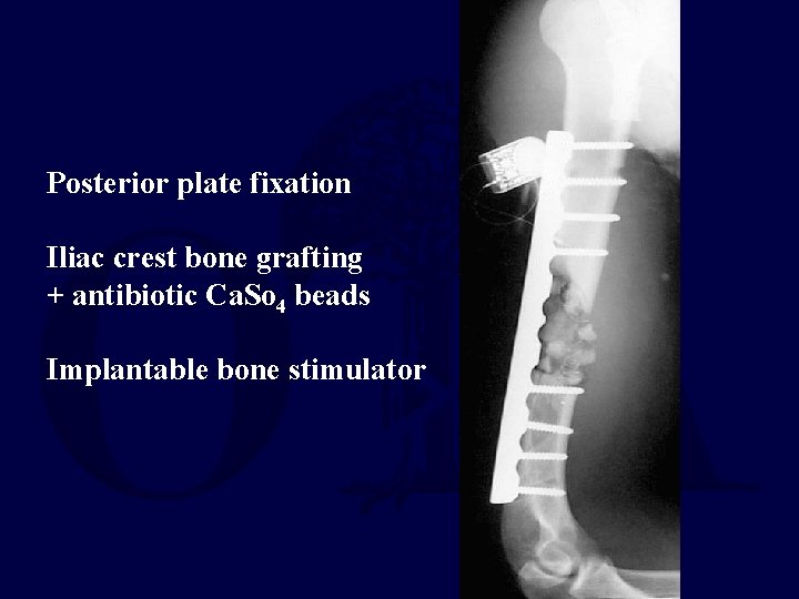 Posterior plate fixation Iliac crest bone grafting + antibiotic Ca. So 4 beads Implantable
