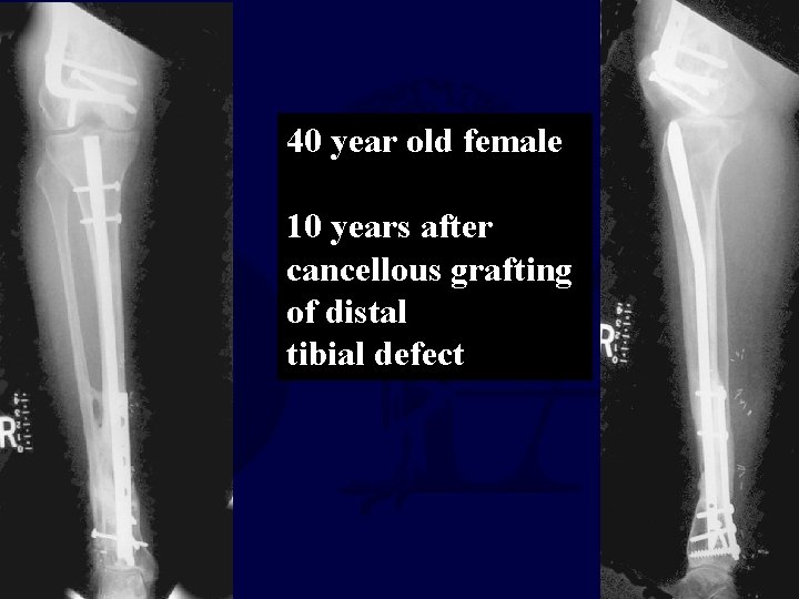 40 year old female 10 years after cancellous grafting of distal tibial defect 