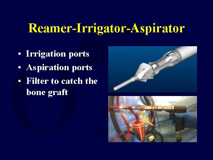 Reamer-Irrigator-Aspirator • Irrigation ports • Aspiration ports • Filter to catch the bone graft