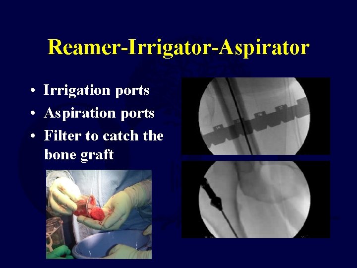 Reamer-Irrigator-Aspirator • Irrigation ports • Aspiration ports • Filter to catch the bone graft