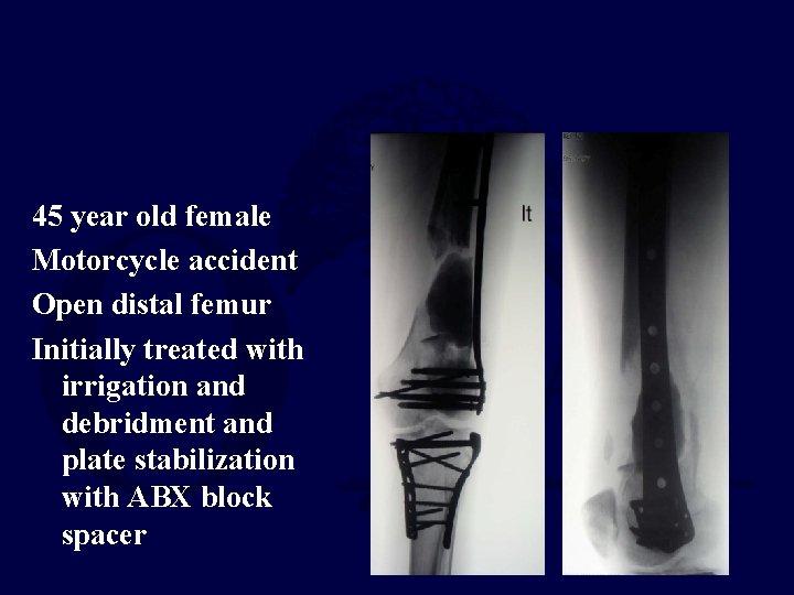 45 year old female Motorcycle accident Open distal femur Initially treated with irrigation and