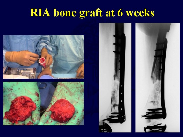 RIA bone graft at 6 weeks 