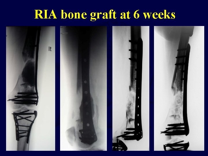RIA bone graft at 6 weeks 