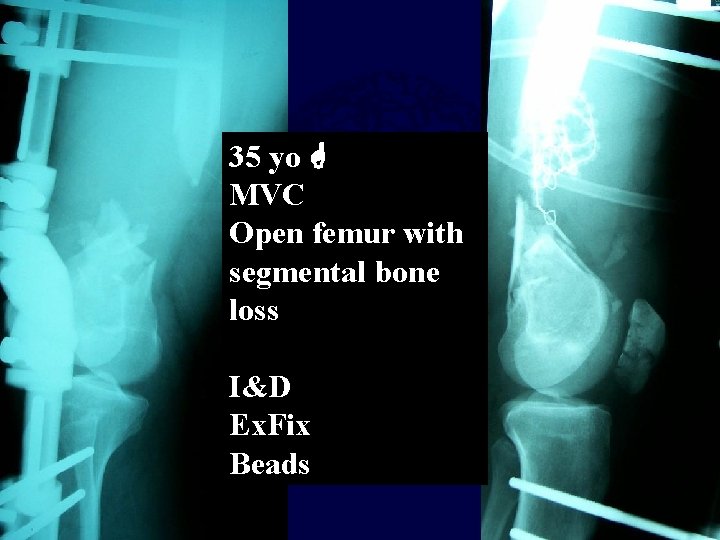 35 yo MVC Open femur with segmental bone loss I&D Ex. Fix Beads 