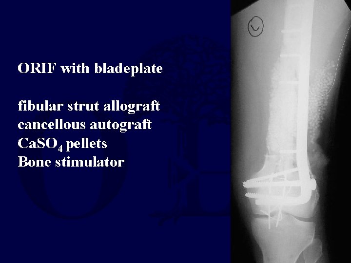 ORIF with bladeplate fibular strut allograft cancellous autograft Ca. SO 4 pellets Bone stimulator