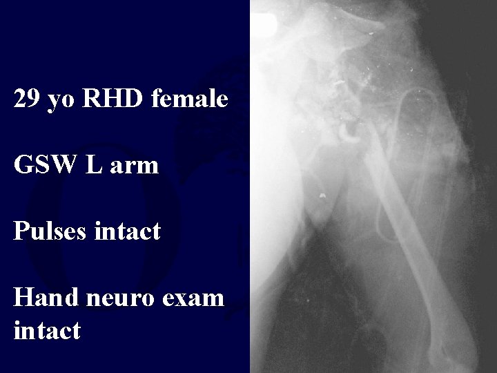 29 yo RHD female GSW L arm Pulses intact Hand neuro exam intact 
