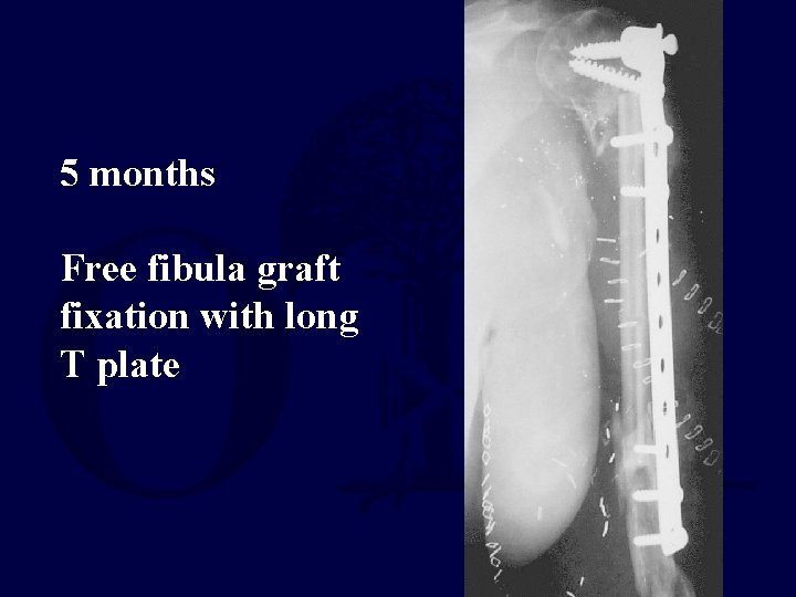 5 months Free fibula graft fixation with long T plate 