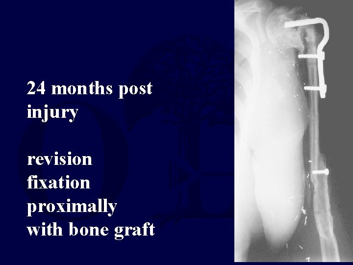 24 months post injury revision fixation proximally with bone graft 