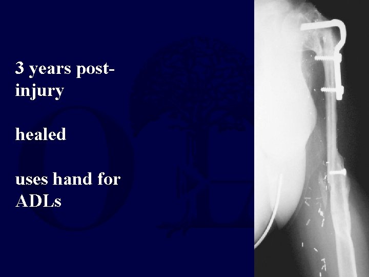 3 years postinjury healed uses hand for ADLs 