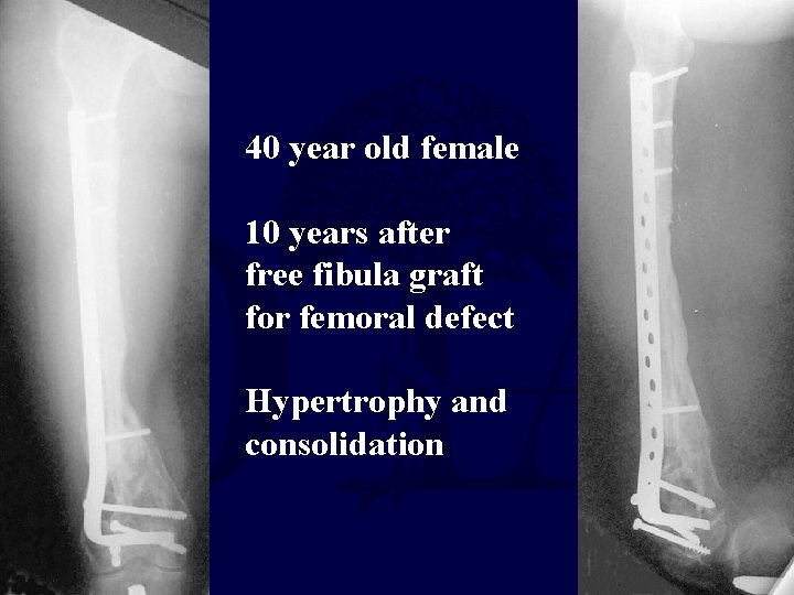 40 year old female 10 years after free fibula graft for femoral defect Hypertrophy