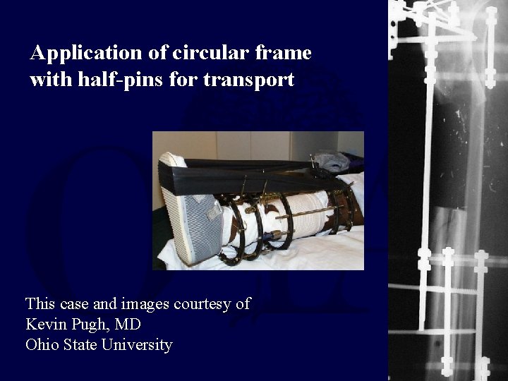 Application of circular frame with half-pins for transport This case and images courtesy of