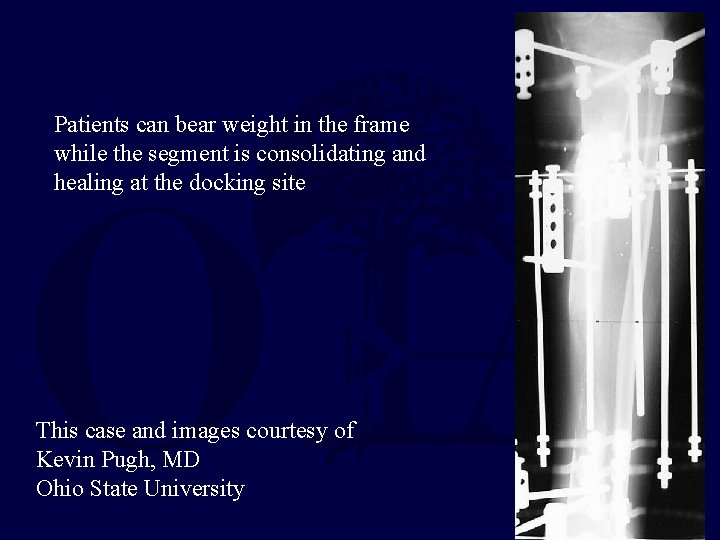 Patients can bear weight in the frame while the segment is consolidating and healing