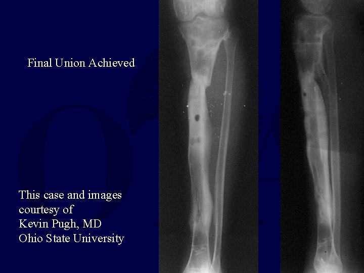 Final Union Achieved This case and images courtesy of Kevin Pugh, MD Ohio State