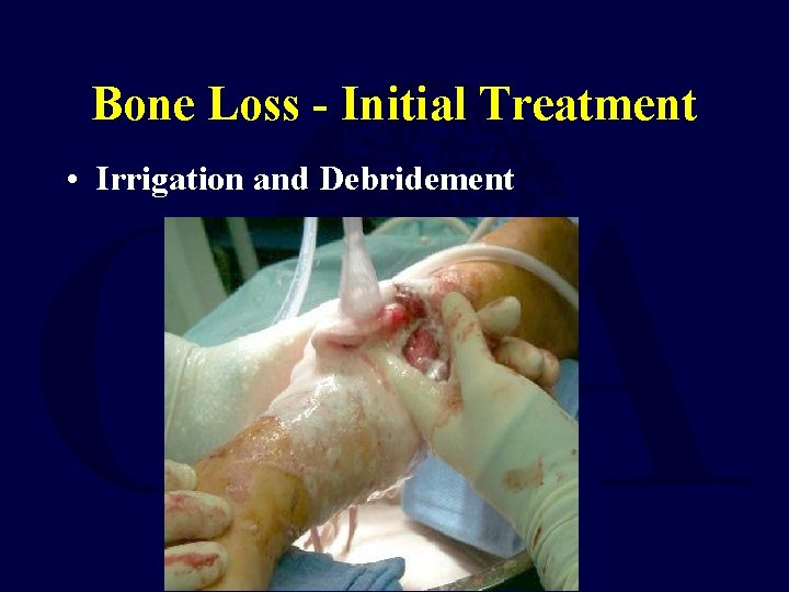 Bone Loss - Initial Treatment • Irrigation and Debridement 