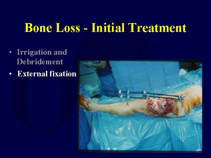 Bone Loss - Initial Treatment • Irrigation and Debridement • External fixation 