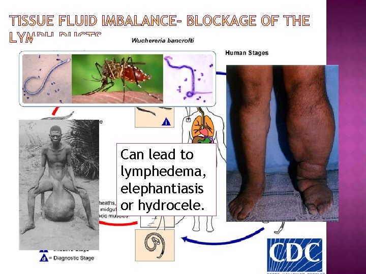 Can lead to lymphedema, elephantiasis or hydrocele. 