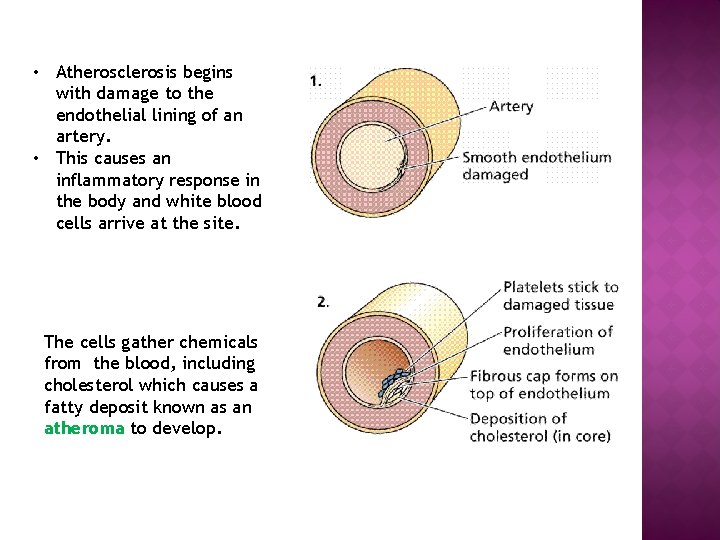  • Atherosclerosis begins with damage to the endothelial lining of an artery. •