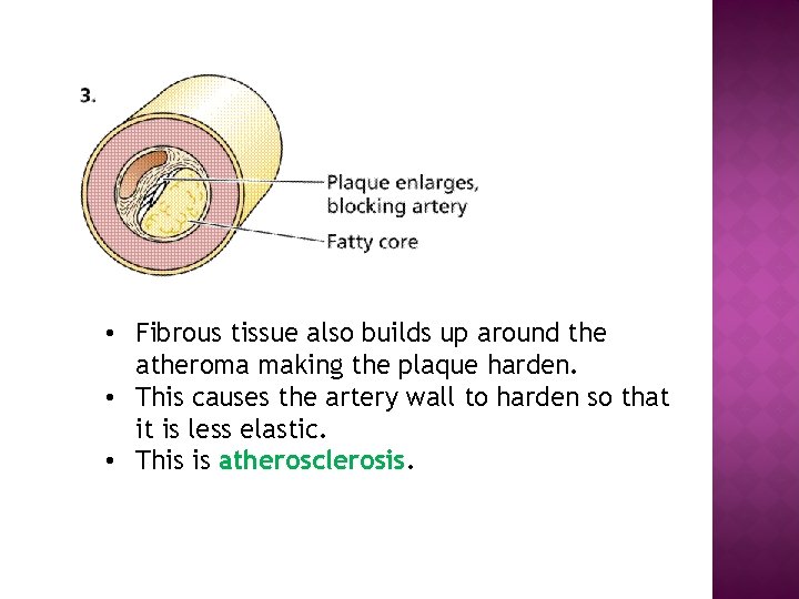  • Fibrous tissue also builds up around the atheroma making the plaque harden.