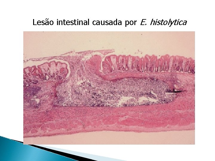 Lesão intestinal causada por E. histolytica 