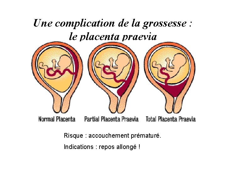 Une complication de la grossesse : le placenta praevia Risque : accouchement prématuré. Indications